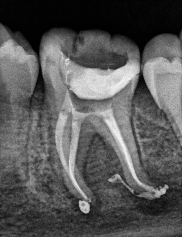 Radiografía final del molar inferior tras la endodoncia