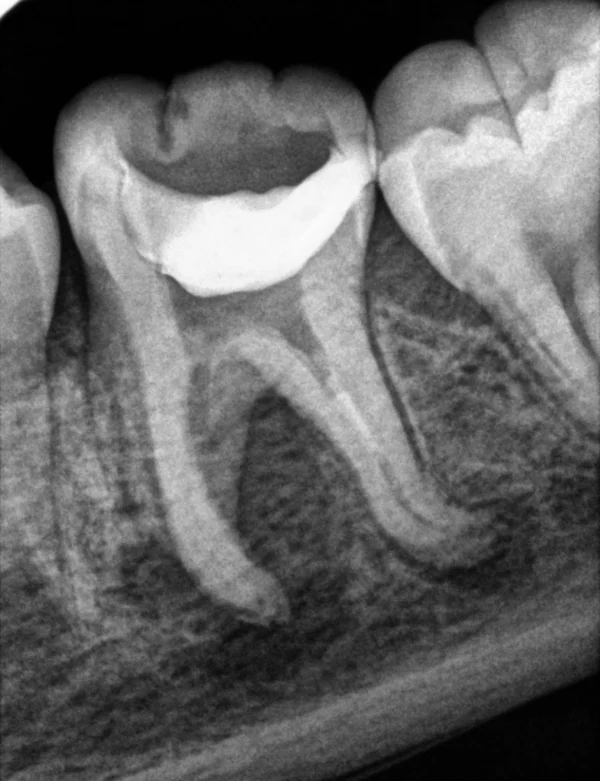 Radiografía inicial de un molar inferior
