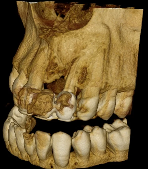 Reconstrucción 3D en la revisión, con el hueso regenerándose