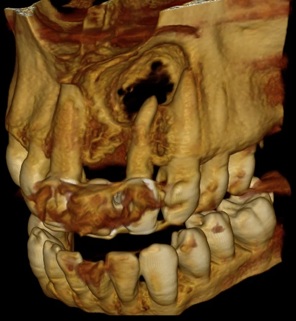 Reconstrucción 3D inicial con una gran lesión en el hueso del maxilar