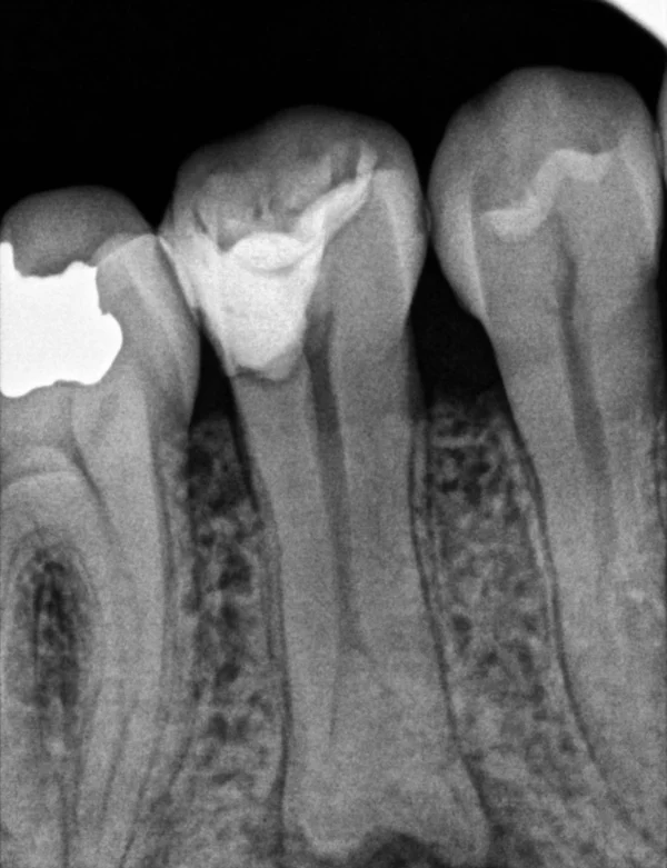 Radiografía inicial de un premolar inferior