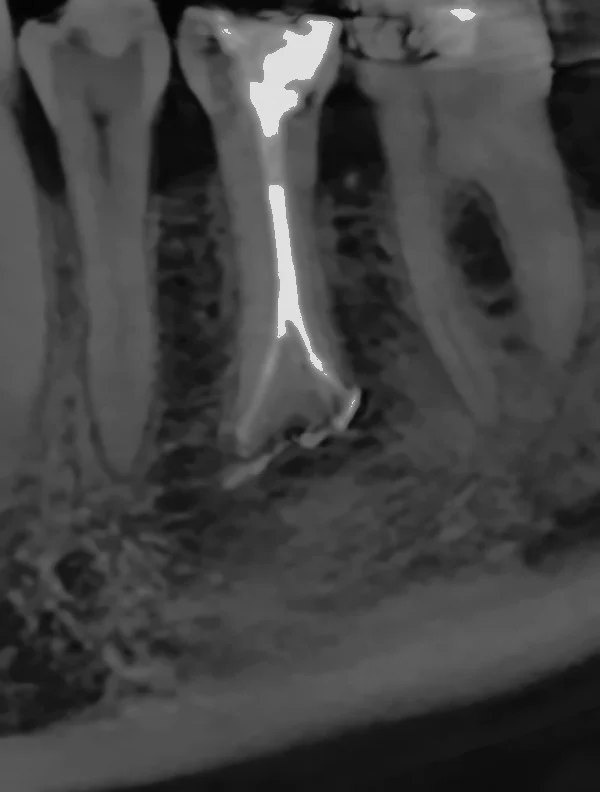 Corte sagital de CBCT en la revisión