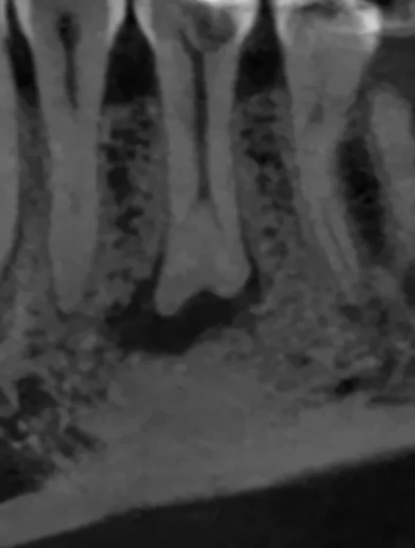 Corte sagital de CBCT antes del tratamiento