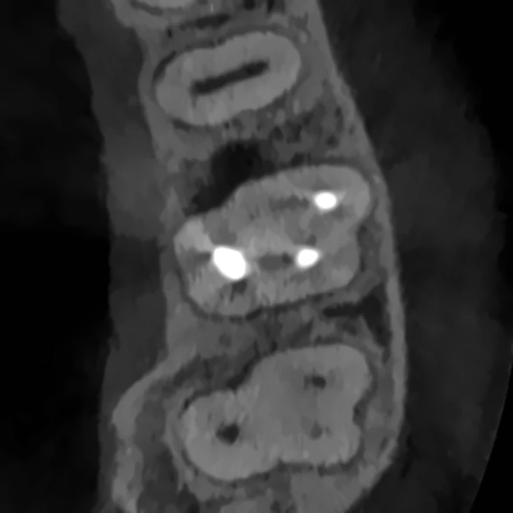 Corte axial de CBCT a la altura de las raíces del molar