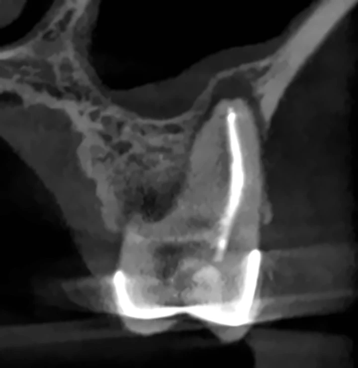 Corte coronal de CBCT del mismo molar
