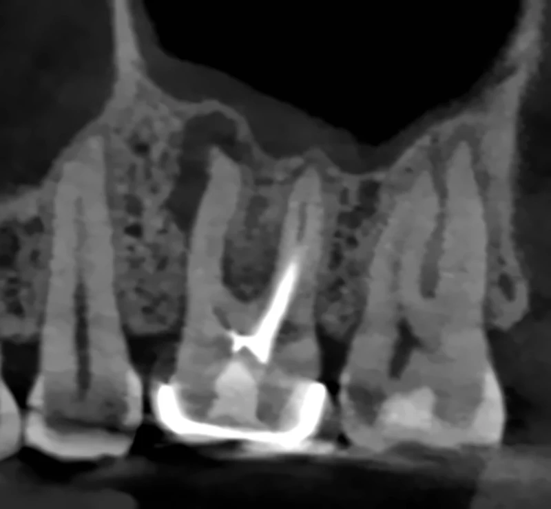 Corte sagital de CBCT de un molar superior con lesión periapical